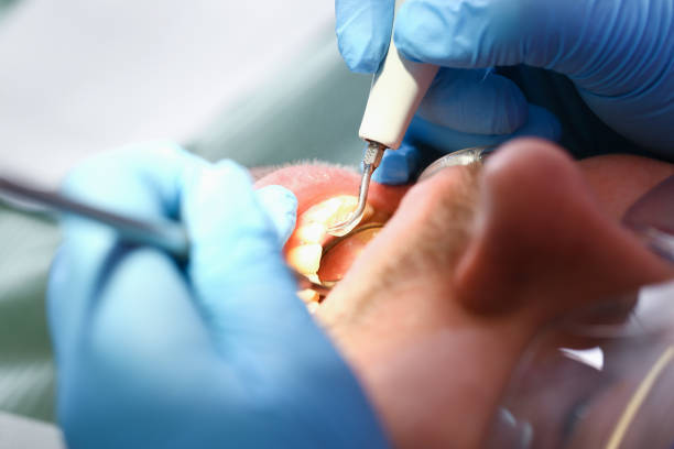 Best Dentist for Tooth Abscess  in San Elizario, TX